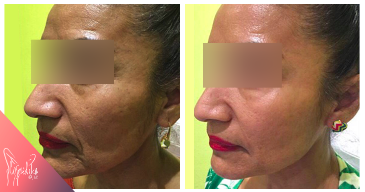 before-after-hyaluronic2