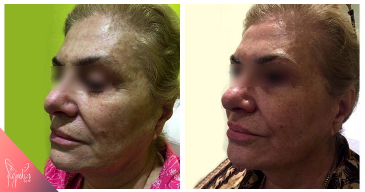 before-after-hyaluronic3