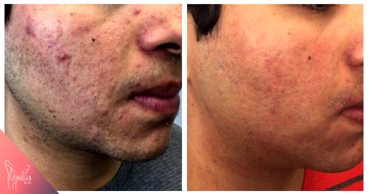 before-after-multivit1